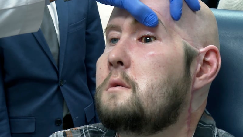 Dr. Eduardo Rodriguez, NYU Langone Health's chair of plastic surgery, examines Aaron James in...